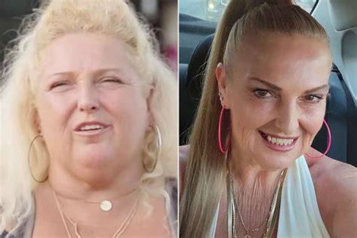 Angela Deem lost 90 lbs weight after the surgery
