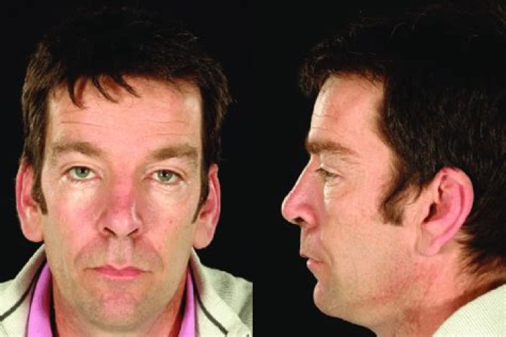 Fabry Disease Patient