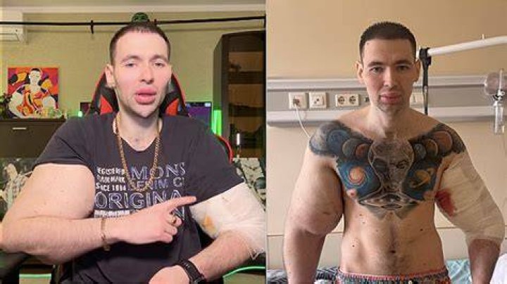 Kirill Tereshin After Surgery