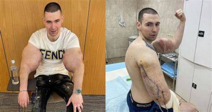 Kirill Tereshin Synthol Oil Muscles