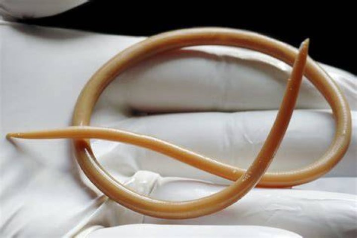 Roundworm In Woman's Brain