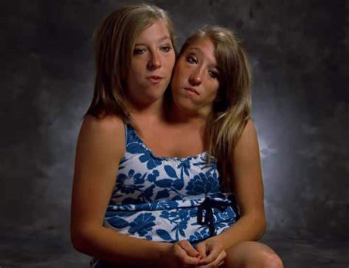 Siamese Twins With Their Wives