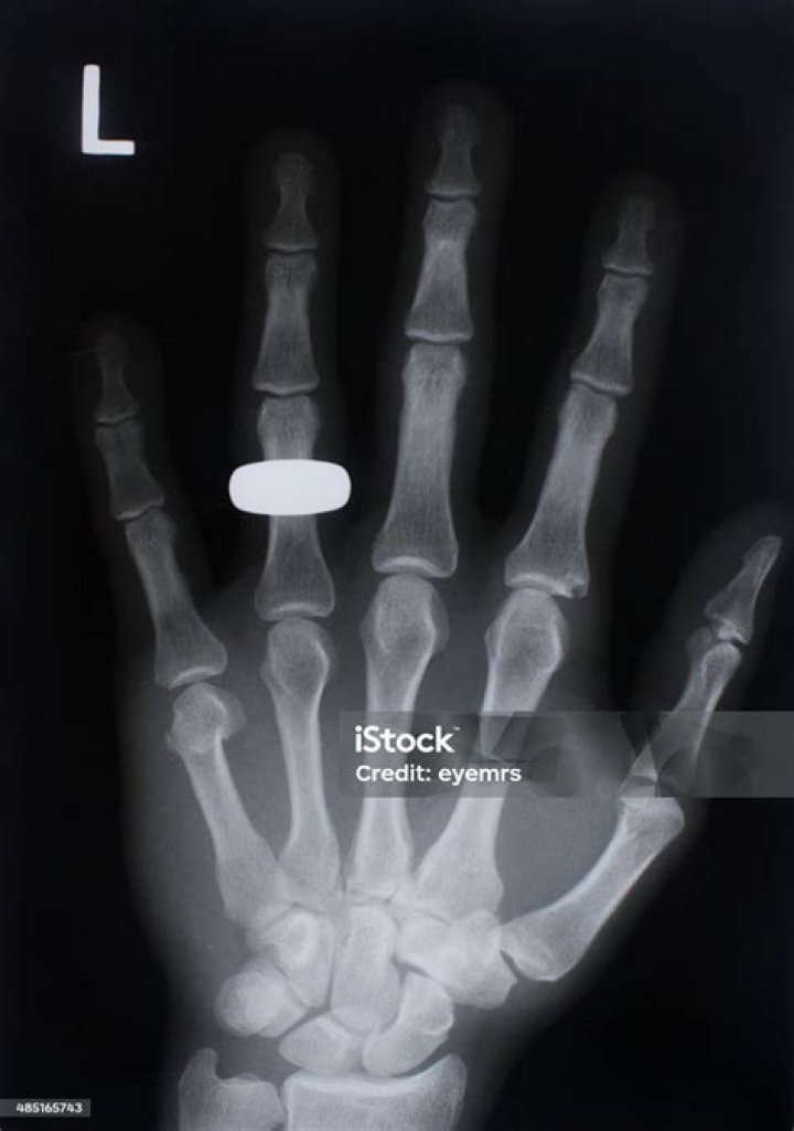X Ray Wedding Ensemble